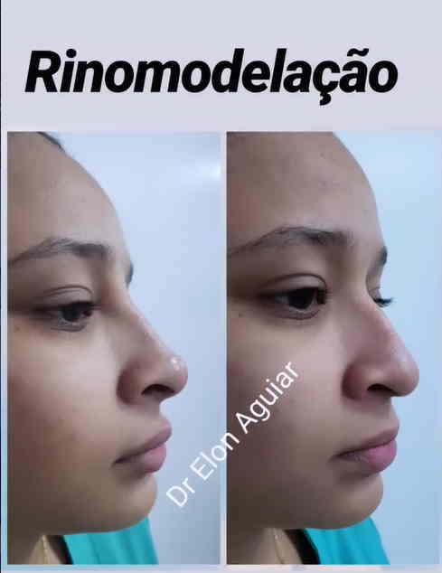 Detalhes da harmonização nasal e rinomodelação na clínica SculptFace
