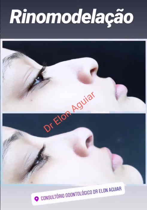 Procedimento de rinomodelação estética do nariz
