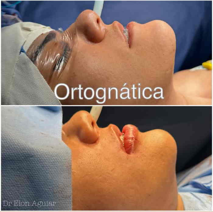 Paciente após cirurgia ortognática em Manaus na Sculptface