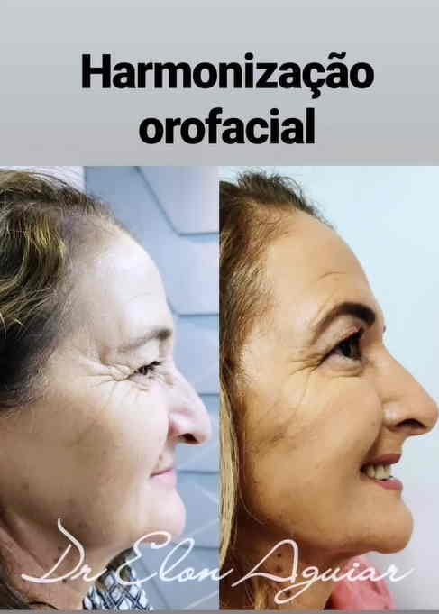Profissional realizando marcações estéticas no rosto de uma paciente para harmonização orofacial em Manaus