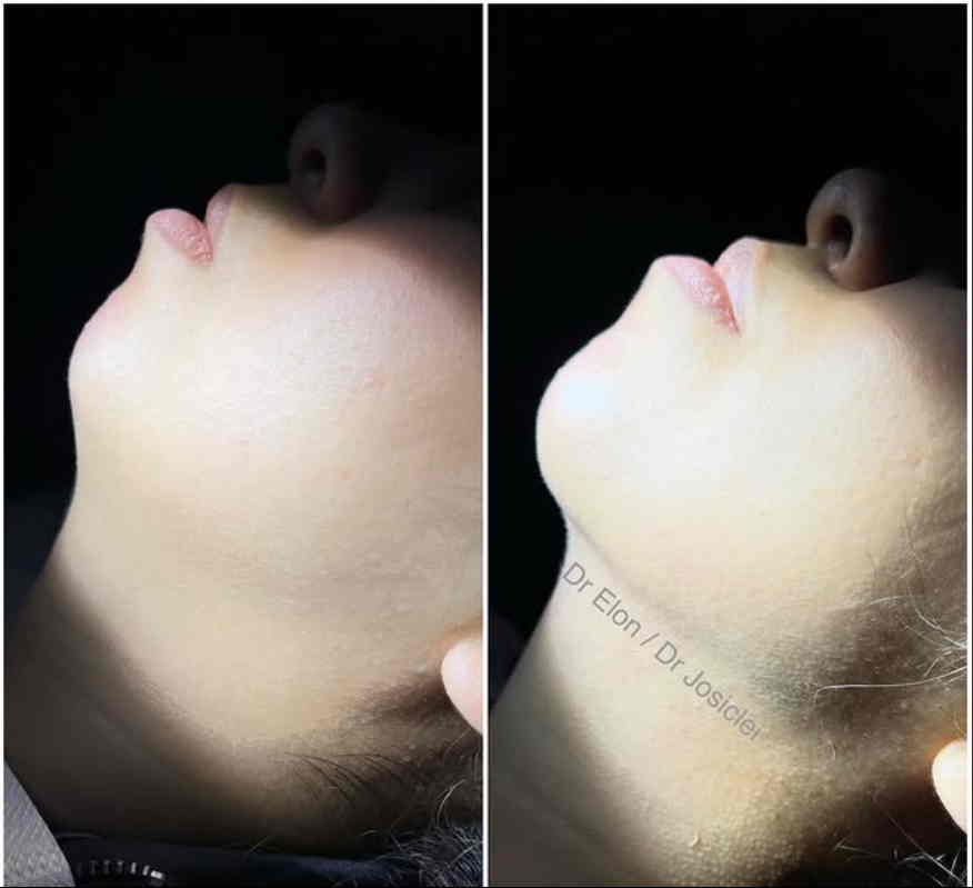Marcações e planejamento para lipoaspiração cervical