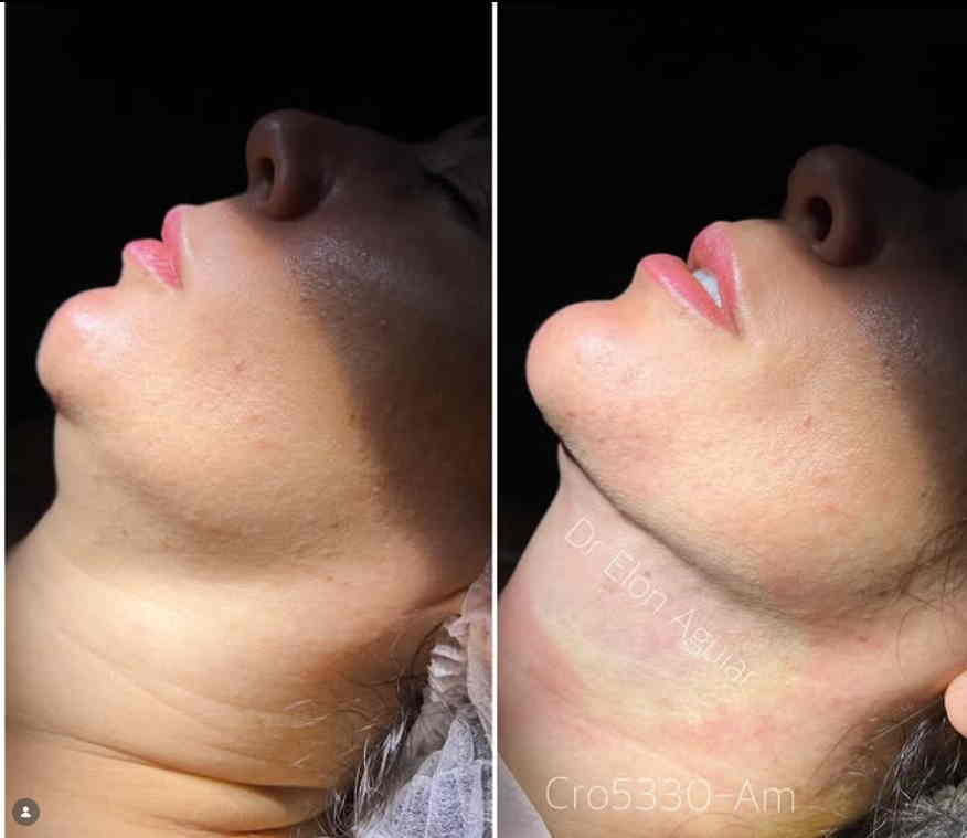 Detalhe do contorno mandibular após lipo de papada