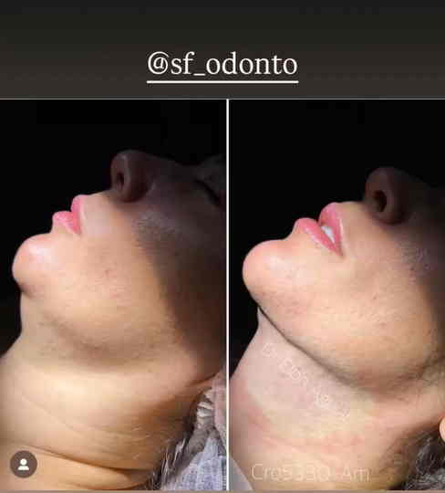 Procedimento de lipo de papada em Manaus
