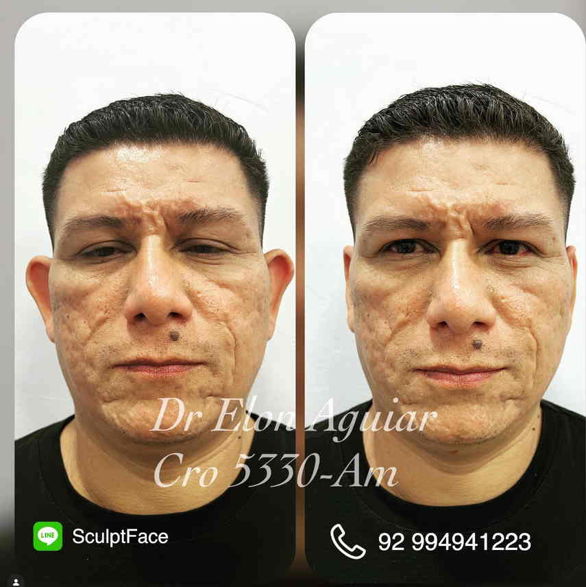Procedimento de otomodelação e correção estética da orelha em Manaus