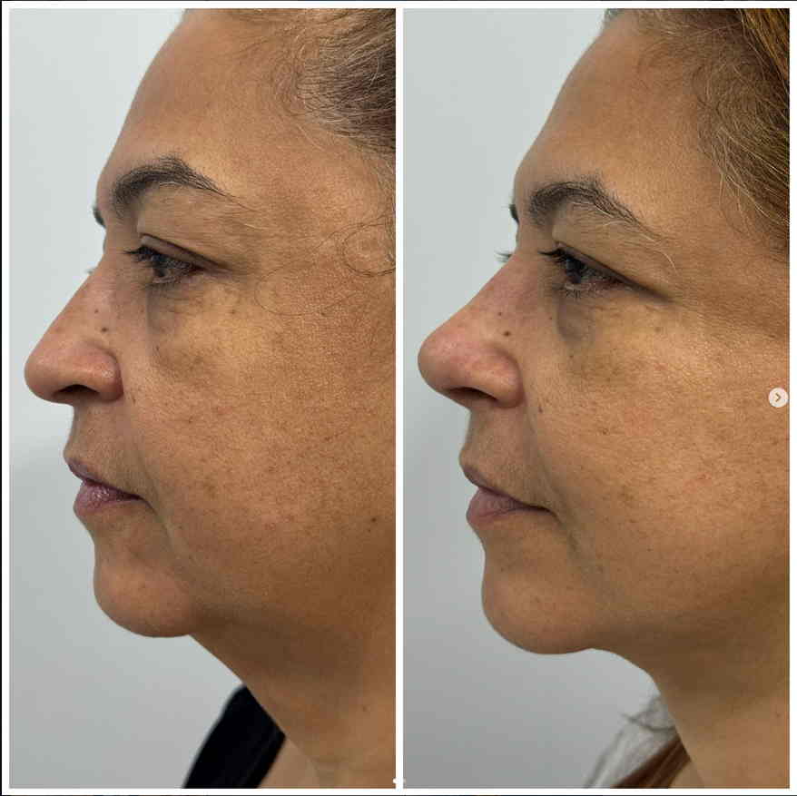 Profissional realizando preparo para cirurgia de facelift e rinoplastia em Manaus