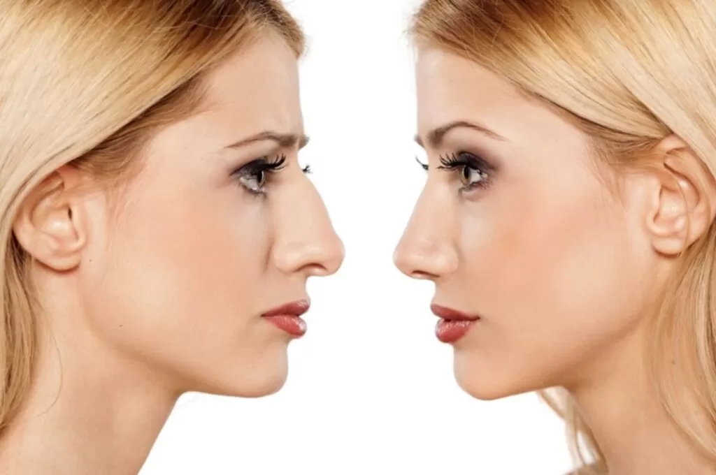 Antes e depois de rinoplastia estruturada em Manaus